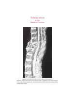Tuberculosis of the Skeletal System 4th.pdf